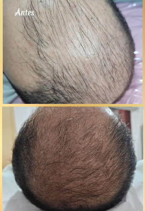 Tratamento Capilar para Queda no Ipiranga | Studio Mary Bessa